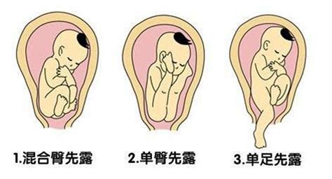 臀先露六种胎方位图解 有来医生