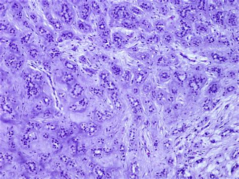 Pathology Outlines Chondroid Syringoma