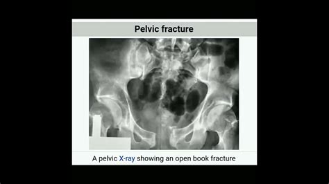 Pelvic Fracture Open Book Fracture Doctor Shortsfeed Short Shortsvideo Youtube