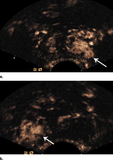 Sonographers Blog Contrast Enhanced Prostate Cancer Detection