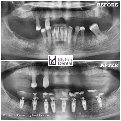 Full Arch Lower Implant Bridge — Blyton Dental
