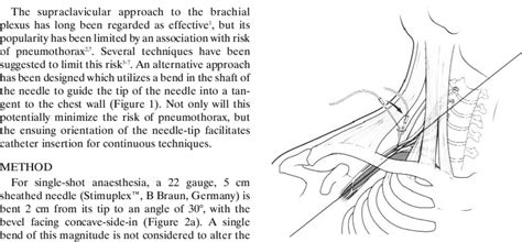 Supraclavicular fossa, with concept of bent needle illustrated. | Download Scientific Diagram