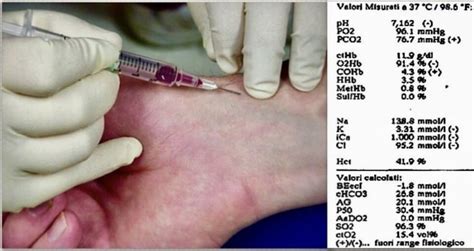 Emogasanalisi Arteriosa EGA Medicina Chirurgia