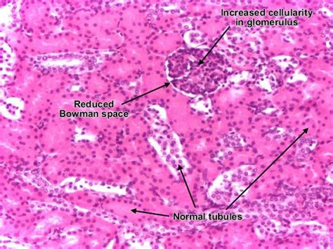Diffuse Proliferative Glomerulonephritis Em
