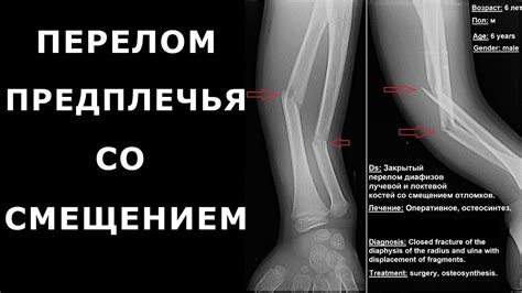 Перелом костей предплечья - YouTube