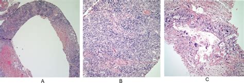 A) Panoramic view of a mediastinal biopsy showing two different cell ...