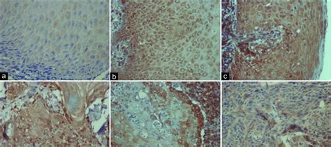 Cyclooxygenase Immunohistochemical Staining In Oral Dysplasia And