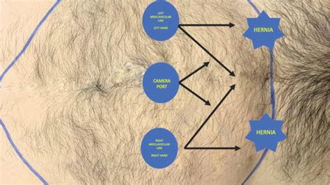 Minimally Invasive Surgery Of The Groin Inguinal Hernia Repair