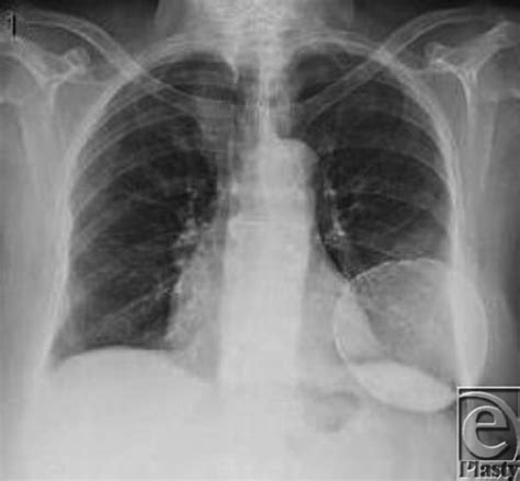 Chest Posteroanterior Identifies A Bone Density Round Calcification Download Scientific Diagram