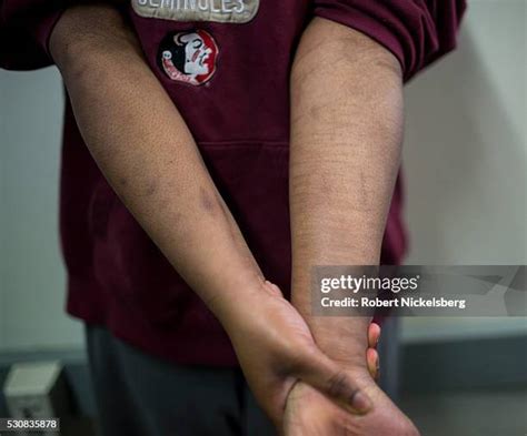 Arm Scars Photos And Premium High Res Pictures Getty Images