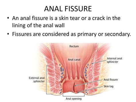 Solution The Learning Of Anorectal Disease That Includes Anal Fissures