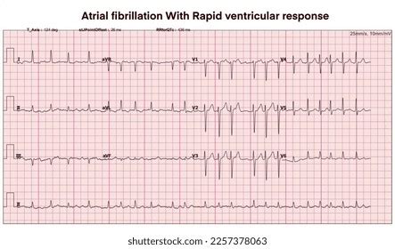 Electrocardiogram Show Atrial Fibrillation Rapid Ventricular Stock