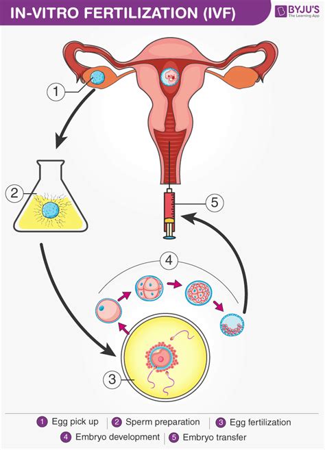 Infertility Different Types Of Assisted Reproductive Technology