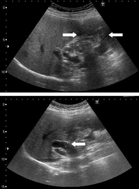 Abdominal Ultrasonography Showing One Mixed Echogenic Tumor