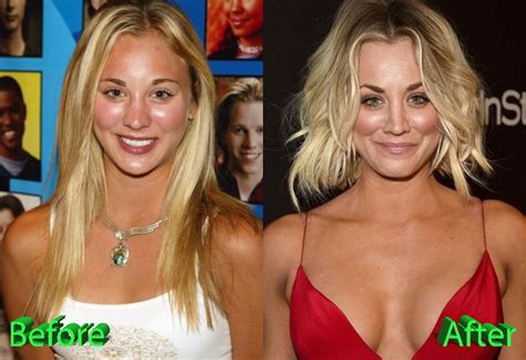 Kaley Cuoco Plastic Surgery: An Example to Follow?