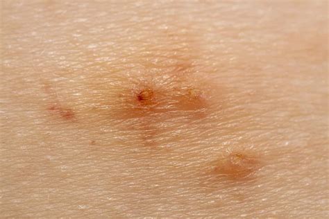 Tratamiento De Cicatrices Molusco Contagioso