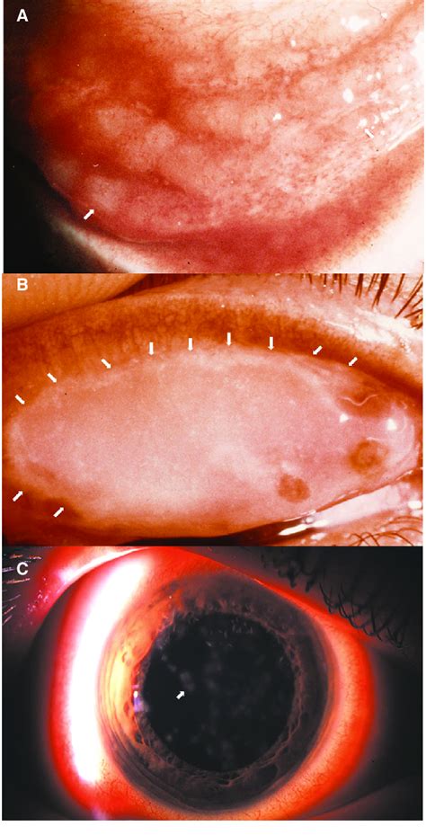 Photomicrographs Of Common Clinical Manifestations Of Ocular Surface In Download Scientific