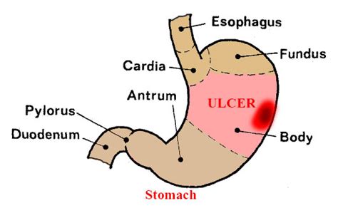 Stomach Ulcer Treatment With Home Remedies by Sachin Goyal