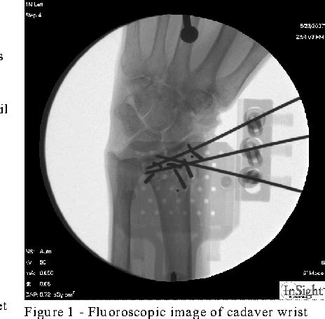 Figure From Biomechanical Comparison Between Volar Plate Fixator Vpf