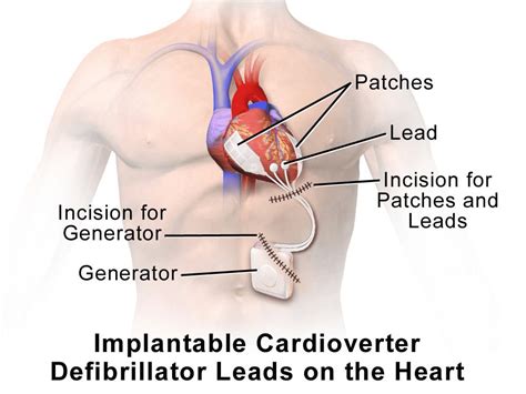 Icd Vs Pacemaker Difference And Comparison