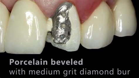 Porcelain Fused To Metal Crown Before And After