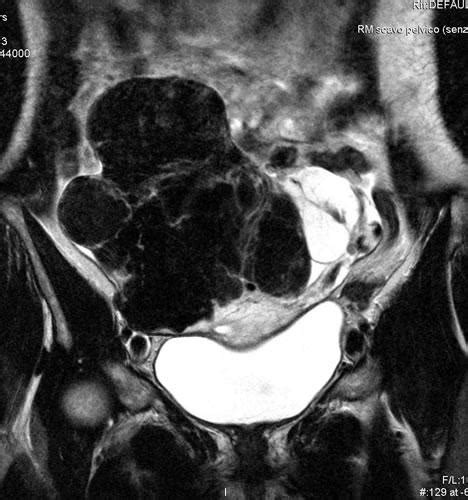 A Gigantic Ovarian Fibroma Mr Imaging Eurorad