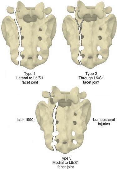 Sacral Fractures Musculoskeletal Key