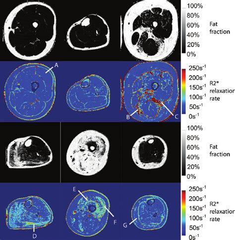 Proton Density Fat Fraction Maps In Black And White With Accompanying