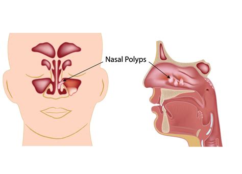 Nasal Polyp Surgery - Fort Worth ENT & Sinus