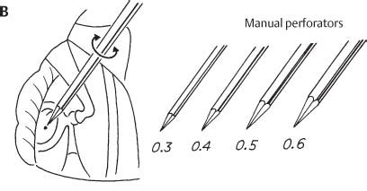 Stapedotomy and Stapedectomy | Ento Key