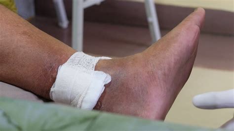 Understanding Venous Stasis Ulcer Las Vegas Vein And Skin Clinic