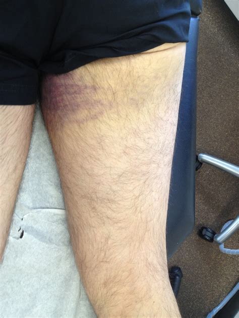 Proximal Hamstring Avulsions The Bone School