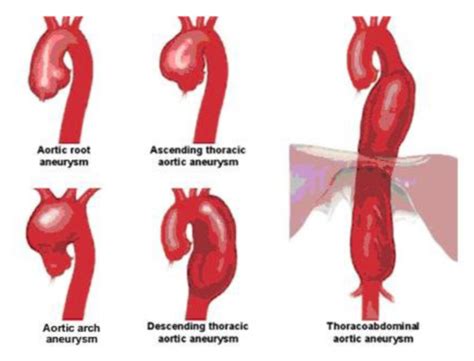 BSII Vascular Disorders Pathophys Flashcards Quizlet