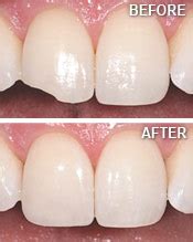 Cosmetic Tooth Bonding Steven Leach Dmd