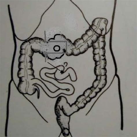 Pdf An Easy Solution For The Diverting Loop Colostomy Our Technique