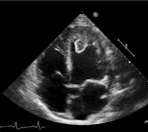 Treatment Of Lv Thrombus Iucn Water