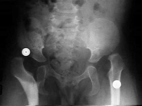 Developmental Dislocation Of The Hip Wheeless Textbook Of Orthopaedics