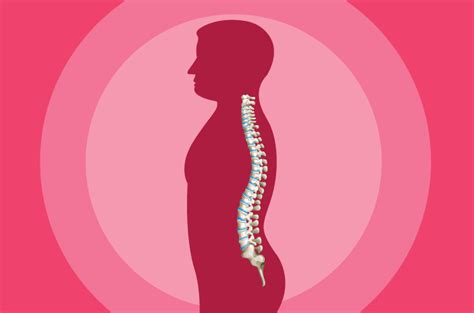 Inilah Yang Dimaksud Lordosis Dan Jenis Jenisnya