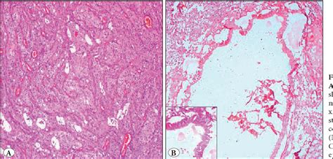 Figure 3 From Primary Retroperitoneal Teratoma With Predominant