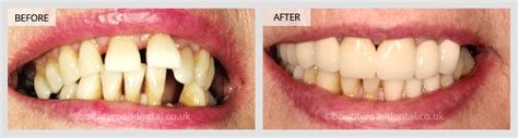 Dental Implants Veneers And Crowns Gallery Bounty Road Dental