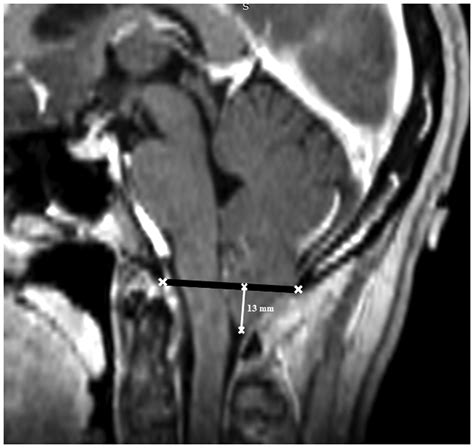 Tonsillar Herniation