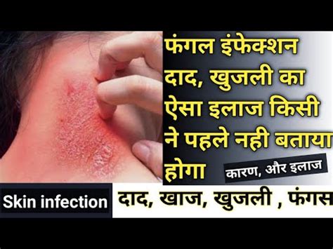 daad khaj khujli ki dawai fungal infection kharish ka ilaj दद