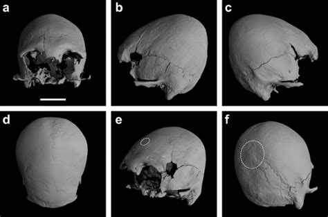 Oldest evidence of cranial deformation in Eurasia found, skull is ...