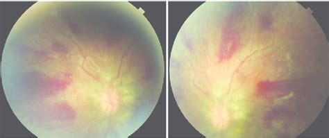 Fundus Photograph Demonstrating Flame Shaped Hemorrhages Download Scientific Diagram