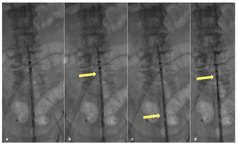 Jcm Free Full Text Partial Deployment To Save Space For Vessel