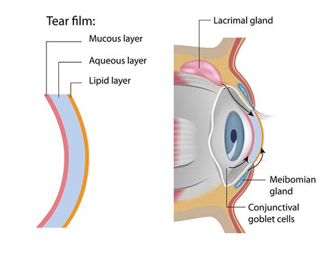 Meibomian Gland Dysfunction Mgd One Of Contributing Factors To Dry Eye Syndrome Royal