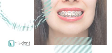 C Mo Funcionan Los Brackets Ybdent Cl Nica Dental Valencia