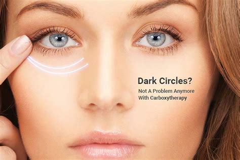 CARBOXY THERAPY