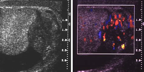 Ultrasound Findings Of Masses Of The Paratesticular Space Clinical