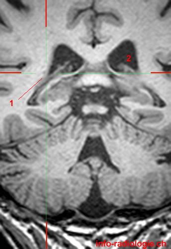 Caudate Nucleus W Radiology